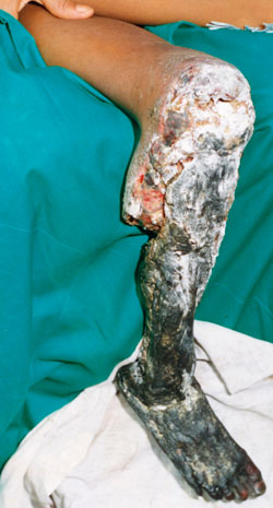 gewebeschaeden_small