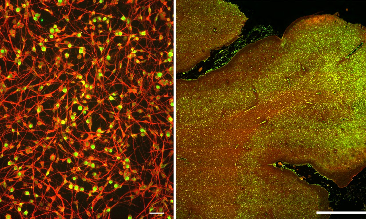 Die Abbildung zeigt induzierten Neuronen von Alzheimer-Patienten