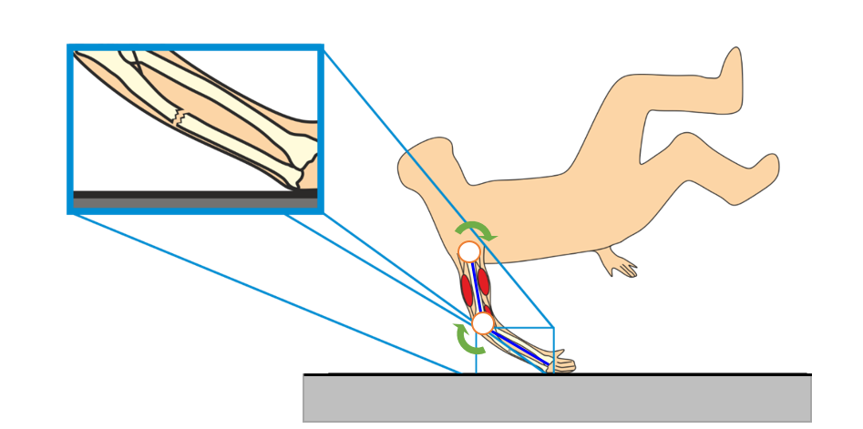 Fracture of the right ulna after a drop (fall).