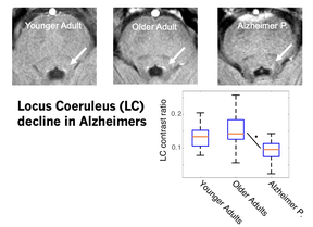 locus coeruleus decline Alheimers