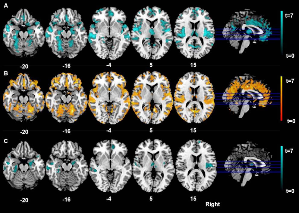(A) gray matter decreases in Anorexia Nervosa patients relative to healthy controls at baseline time point (blue color), (B) increases in Anorexia Nervosa patients from pre to post therapy (orange color), (C) decreases in weight-restored Anorexia Nervosa patients at time-point to relative to healthy controls (blue color). 